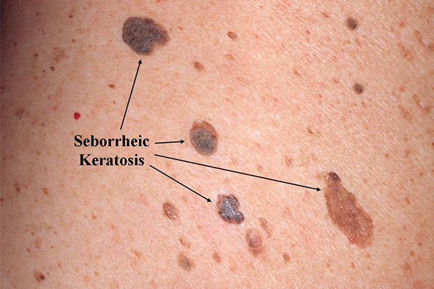 Best Seborrhoeic Keratosis Removal Treatment Clinic In North London
